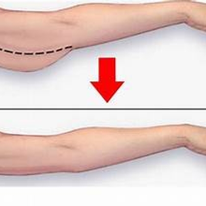 DỊCH VỤ HIFU JESMAS THON GỌN BẮP TAY