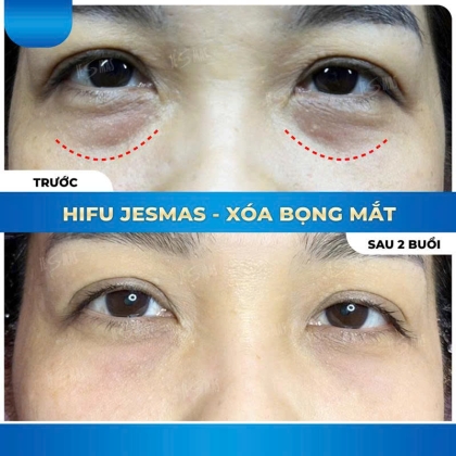 HIFU XÓA BỌNG MẮT