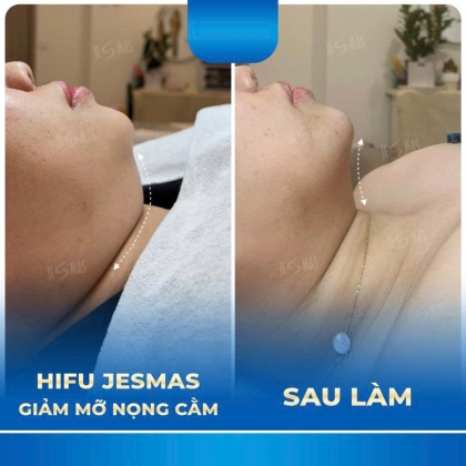 HIFU NỌNG CẰM