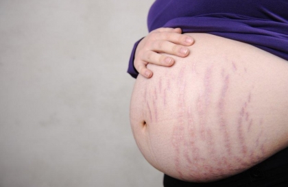 Cách trị ngứa rạn da khi mang thai an toàn cho mẹ và bé bạn cần biết