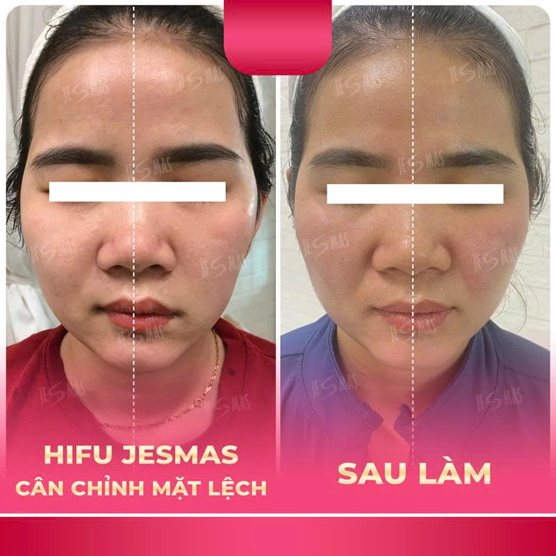 canmatlechhong