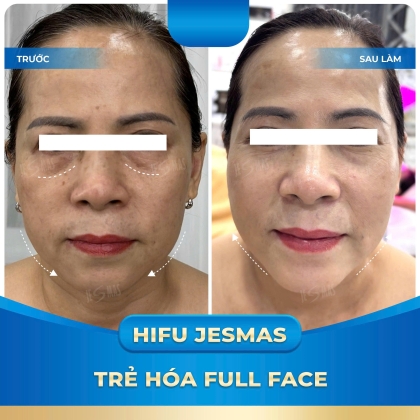 Hifu Trẻ Hóa Full Face