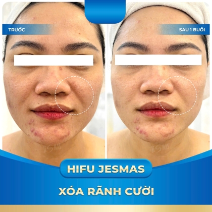 XÓA RÃNH CƯỜI VỚI HIFU JESMAS
