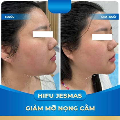 Hifu Giảm Mỡ Nọng Cằm
