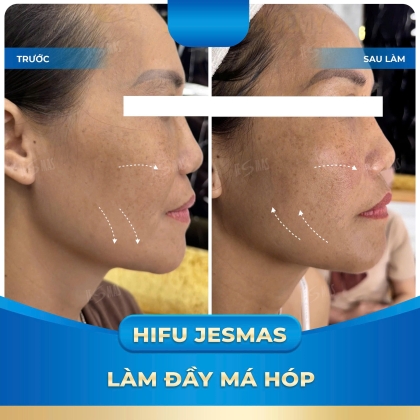 Hifu Làm Đầy Má Hóp