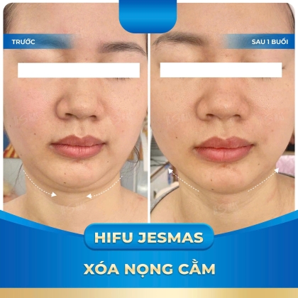 HIFU JESMAS GIẢM MỠ NỌNG CẰM - 1 BUỔI
