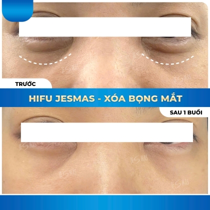 HIFU XÓA BỌNG MẮT - 1 BUỔI
