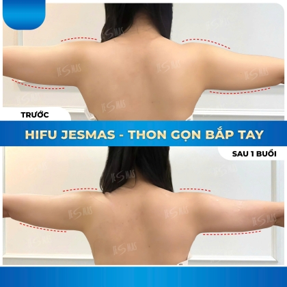 Hifu Bắp Tay - 1 Buổi