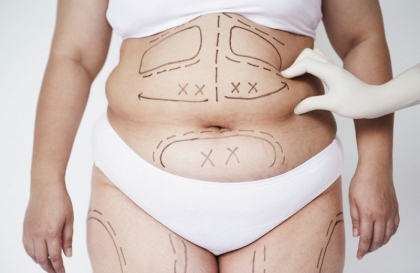 Các dạng bụng mỡ khó giảm ở nam nữ - Cách khắc phục điều trị đánh bay mỡ bụng hiệu quả