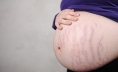 Cách trị ngứa rạn da khi mang thai an toàn cho mẹ và bé bạn cần biết