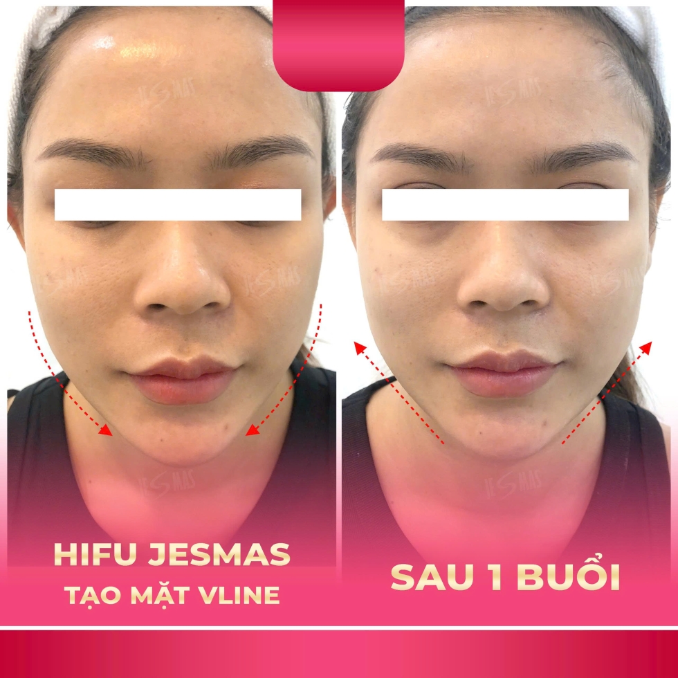 trehoavlinehong
