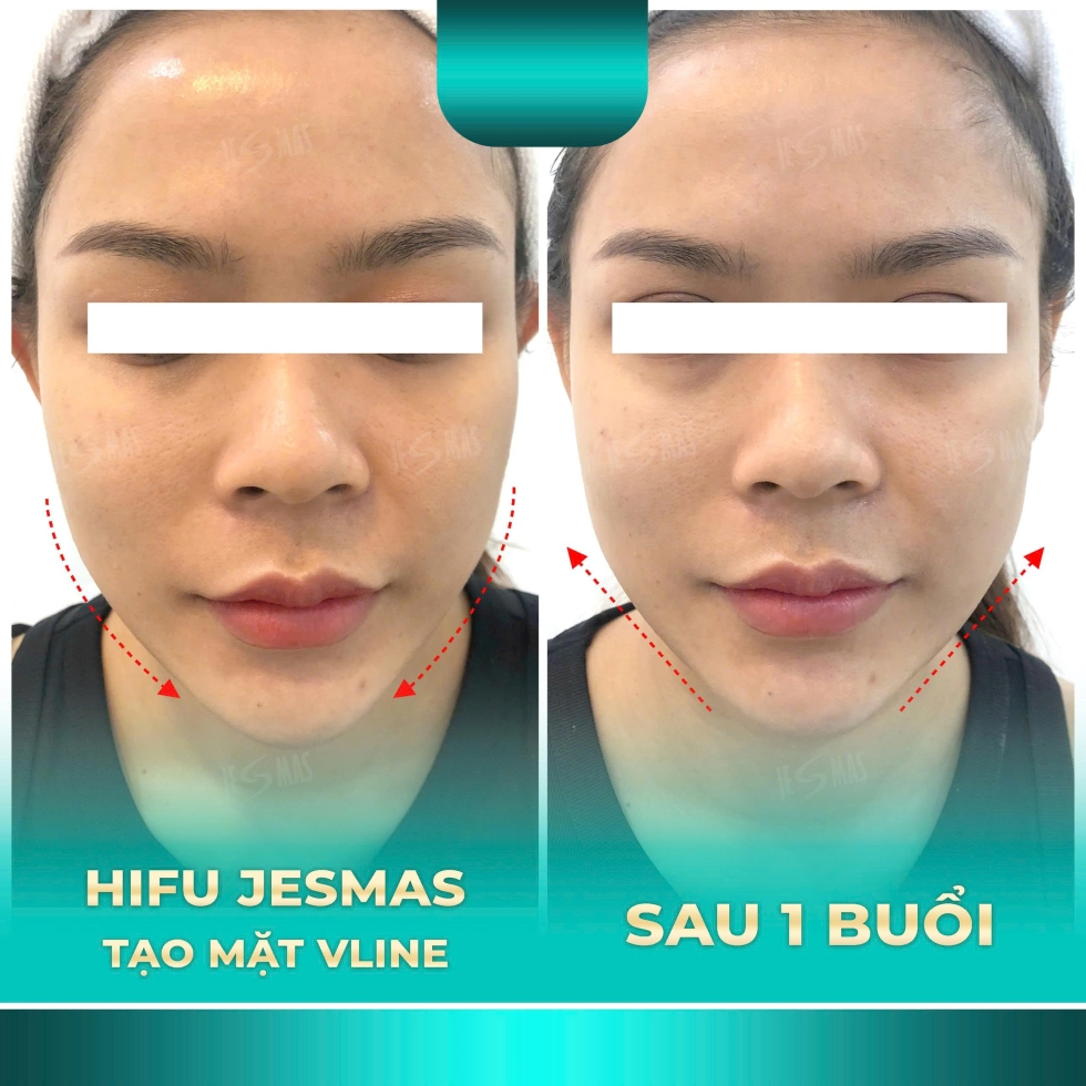 trehoavlinexanhnhat