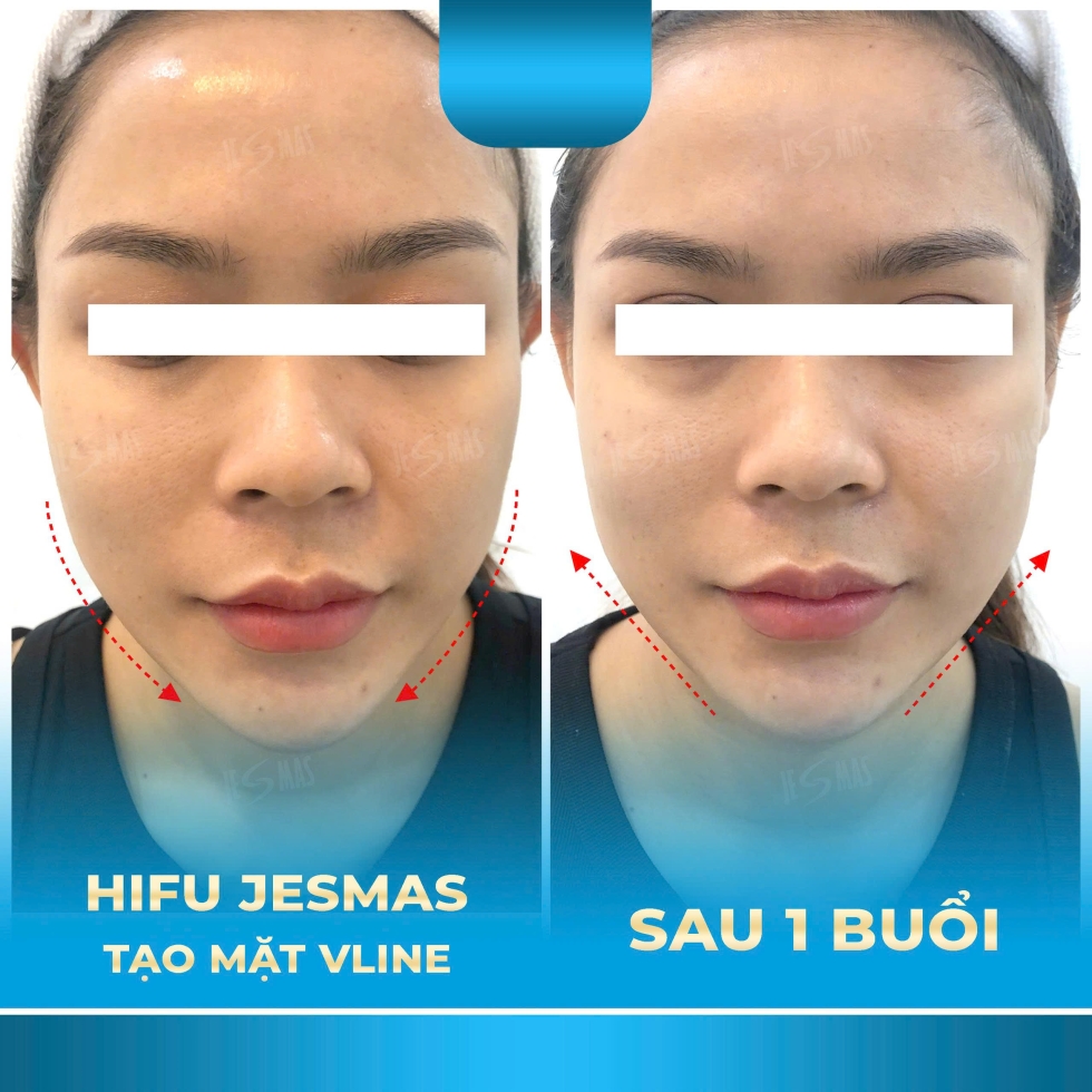 trehoavlinexanhnhat
