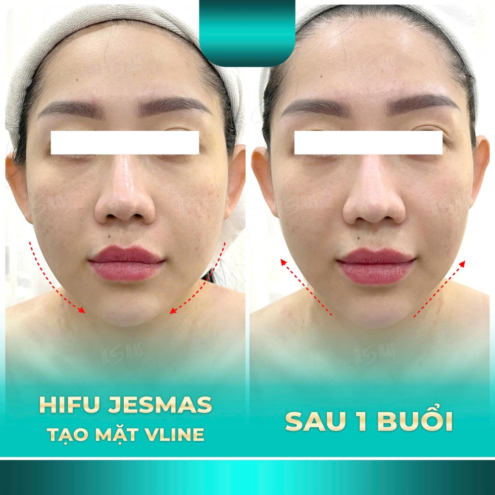 hifujesmastaomatvlinexanhnhat2