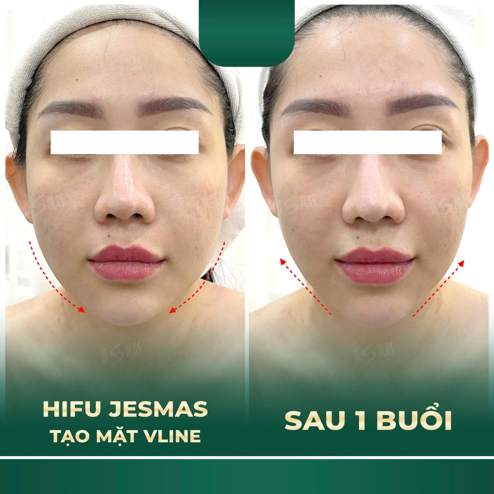 hifujesmastaomatvlinexanhdam2