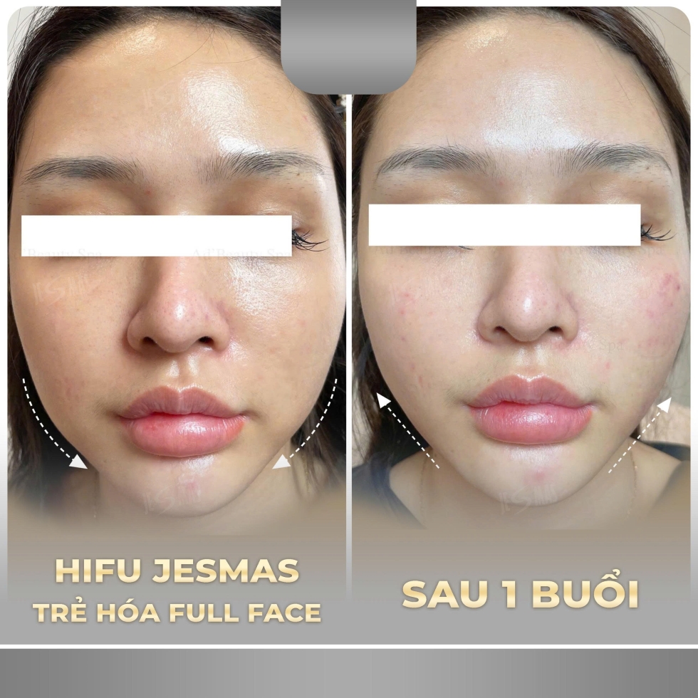 trehoafullface1buoixam