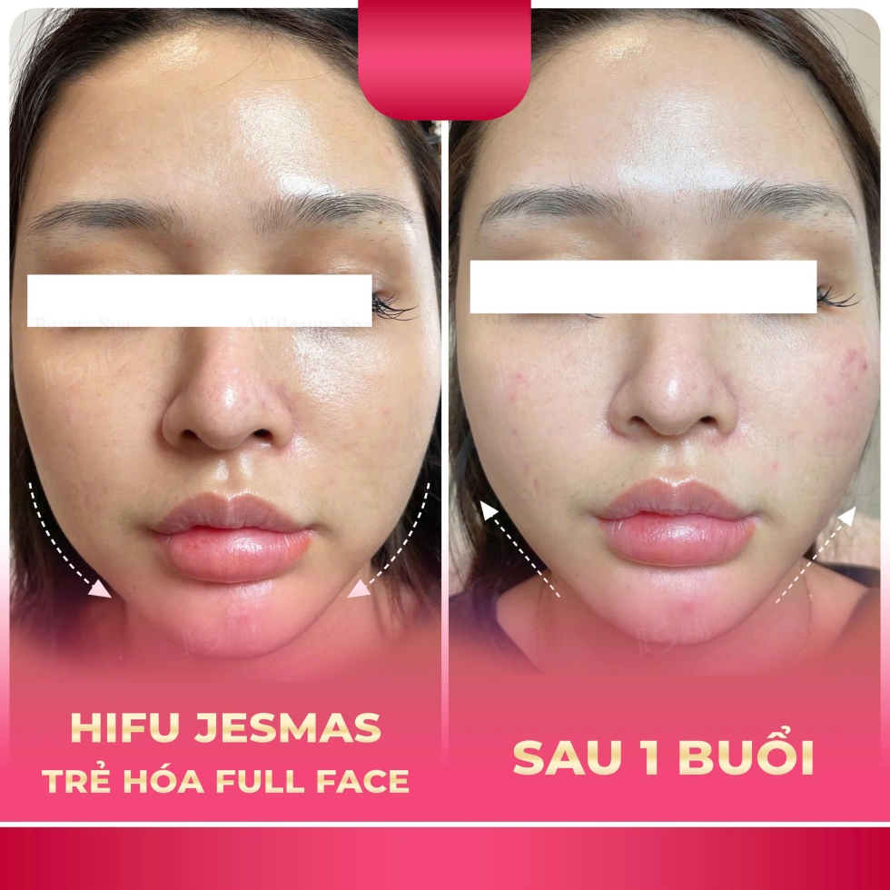 trehoafullface1buoihong
