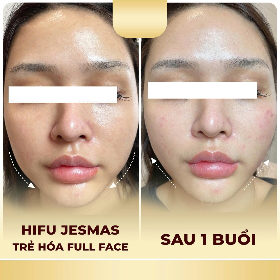trehoafullface1buoivang