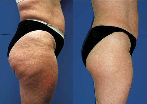 Giảm béo đùi và mông cho người có cơ địa khó giảm cân