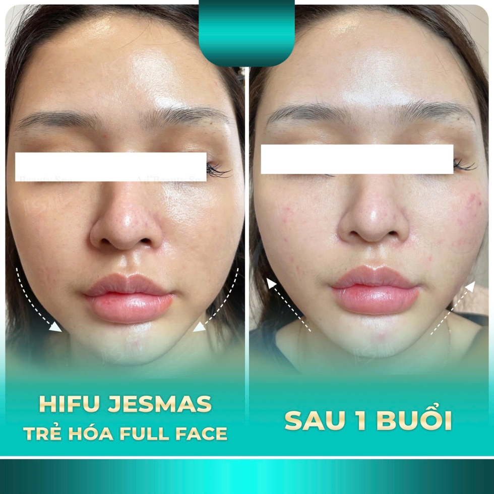trehoafullface1buoixanhnhat2