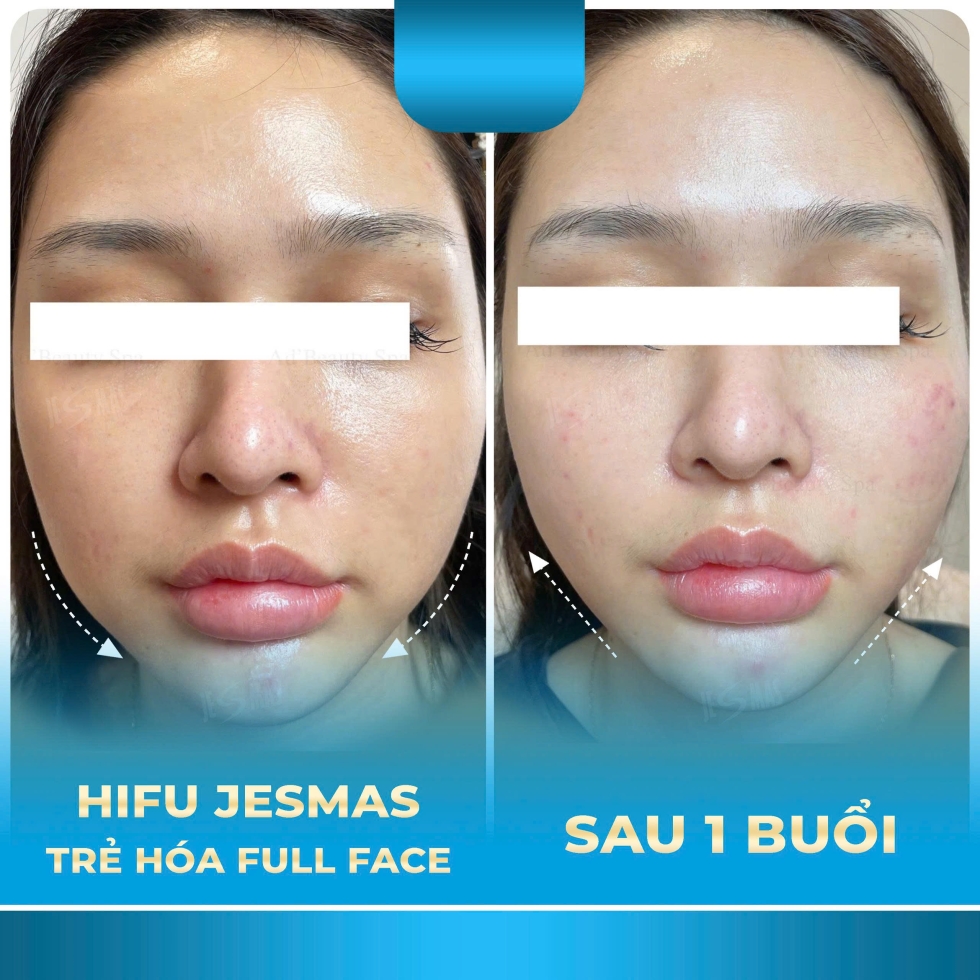 trehoafullface1buoixanhnhat