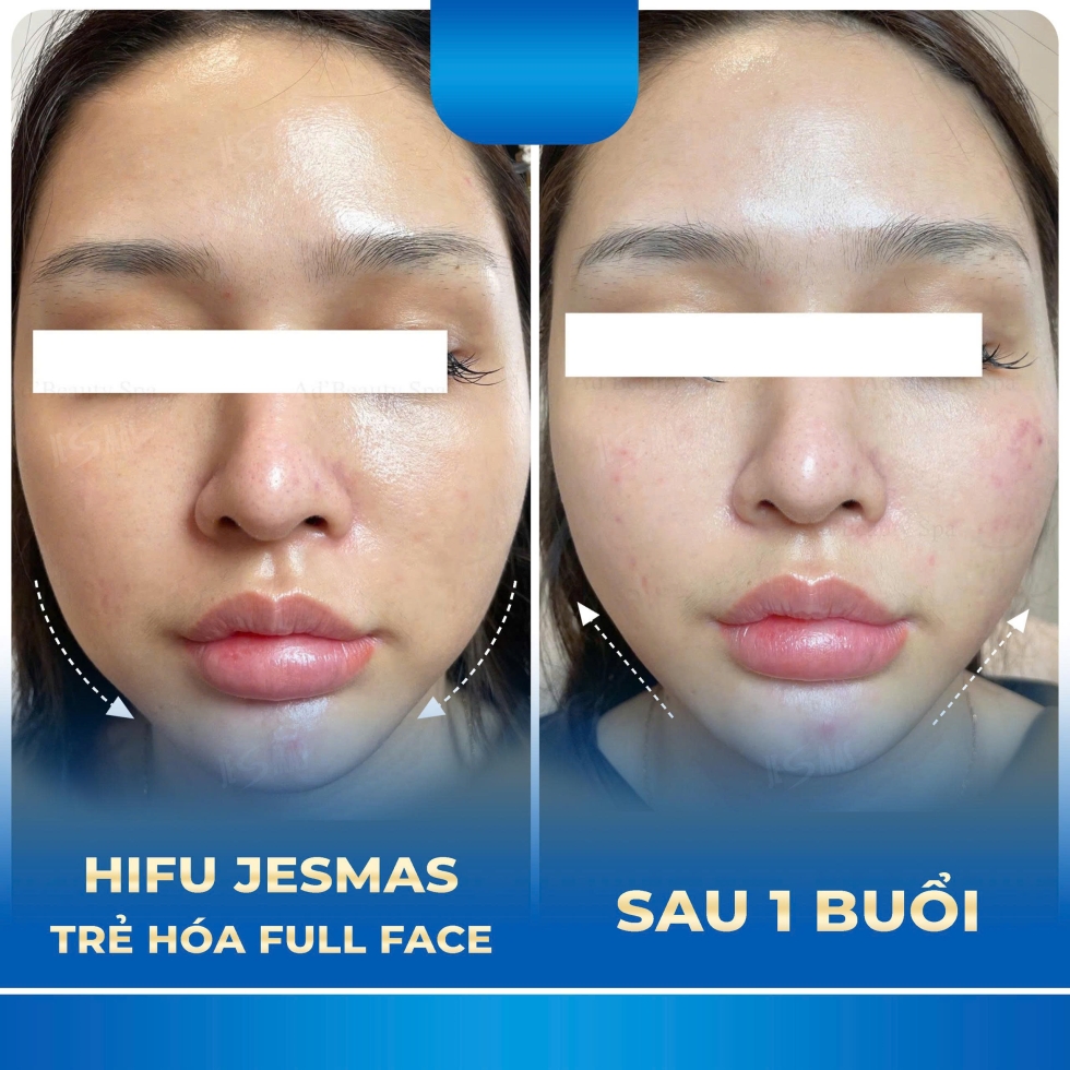 trehoafullface1buoixanhdam
