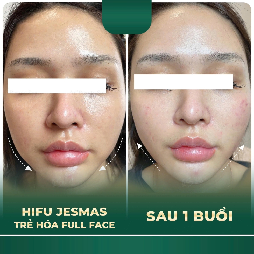 trehoafullface1buoixanhdam2
