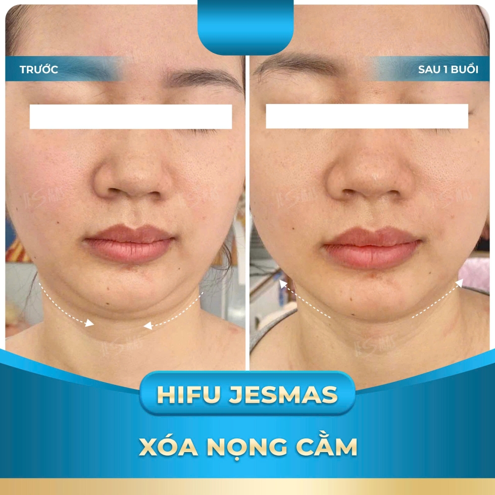 hifujesmasxoanongcamxanhnhat