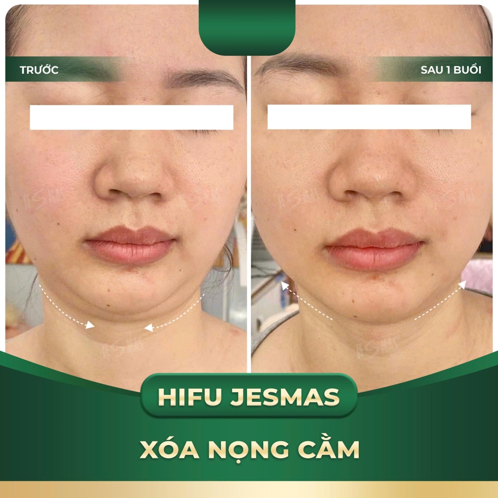 hifujesmasxoanongcamxanhdam2