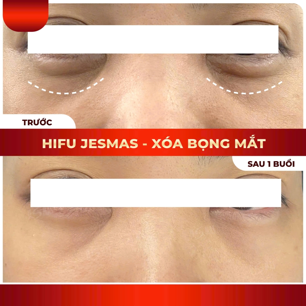 hifuxoabongmatdo