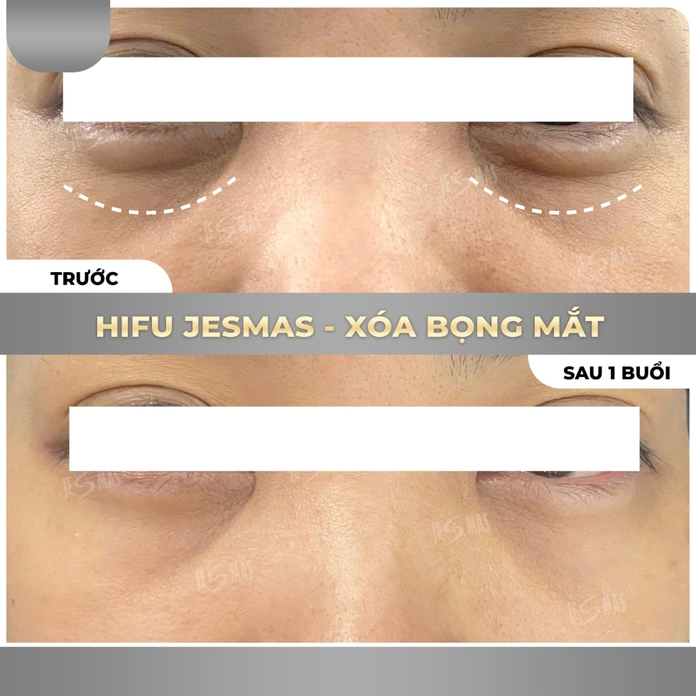 hifuxoabongmatxam