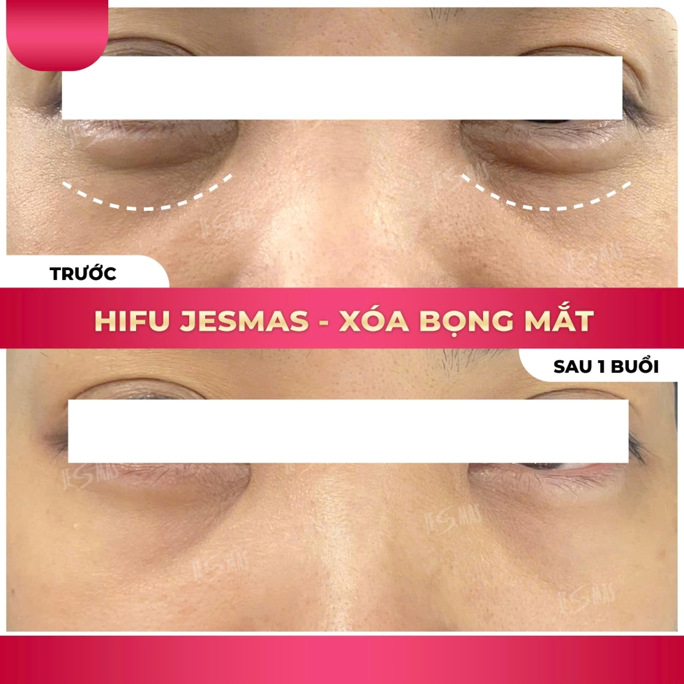 hifuxoabongmathong