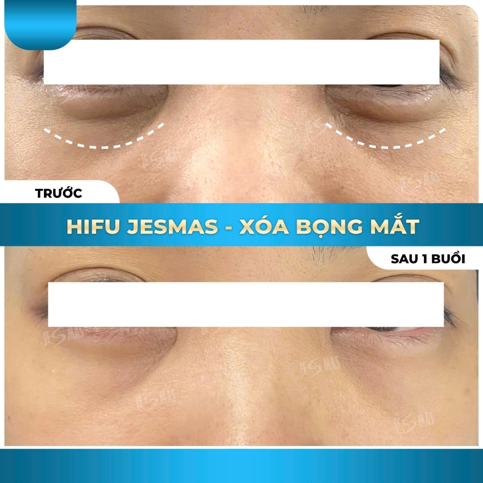 hifuxoabongmatxanhnhat
