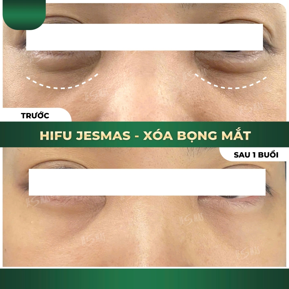 hifuxoabongmatxanhdam2