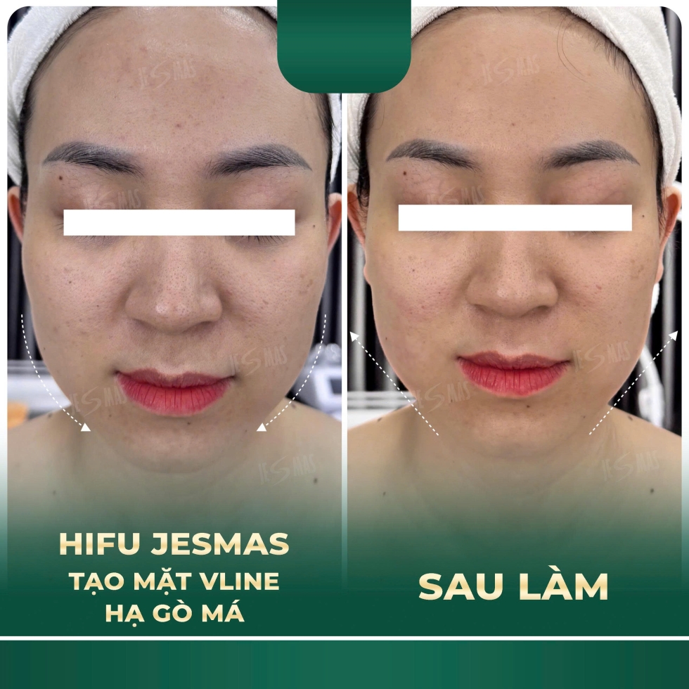hifutaohinhvlinehagomaxanhdam2