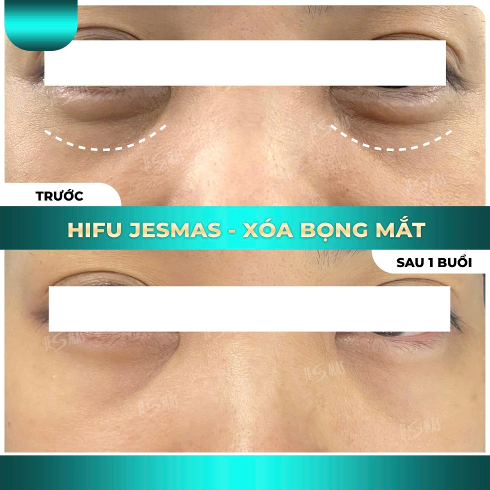 hifuxoabongmatxanhnhat2