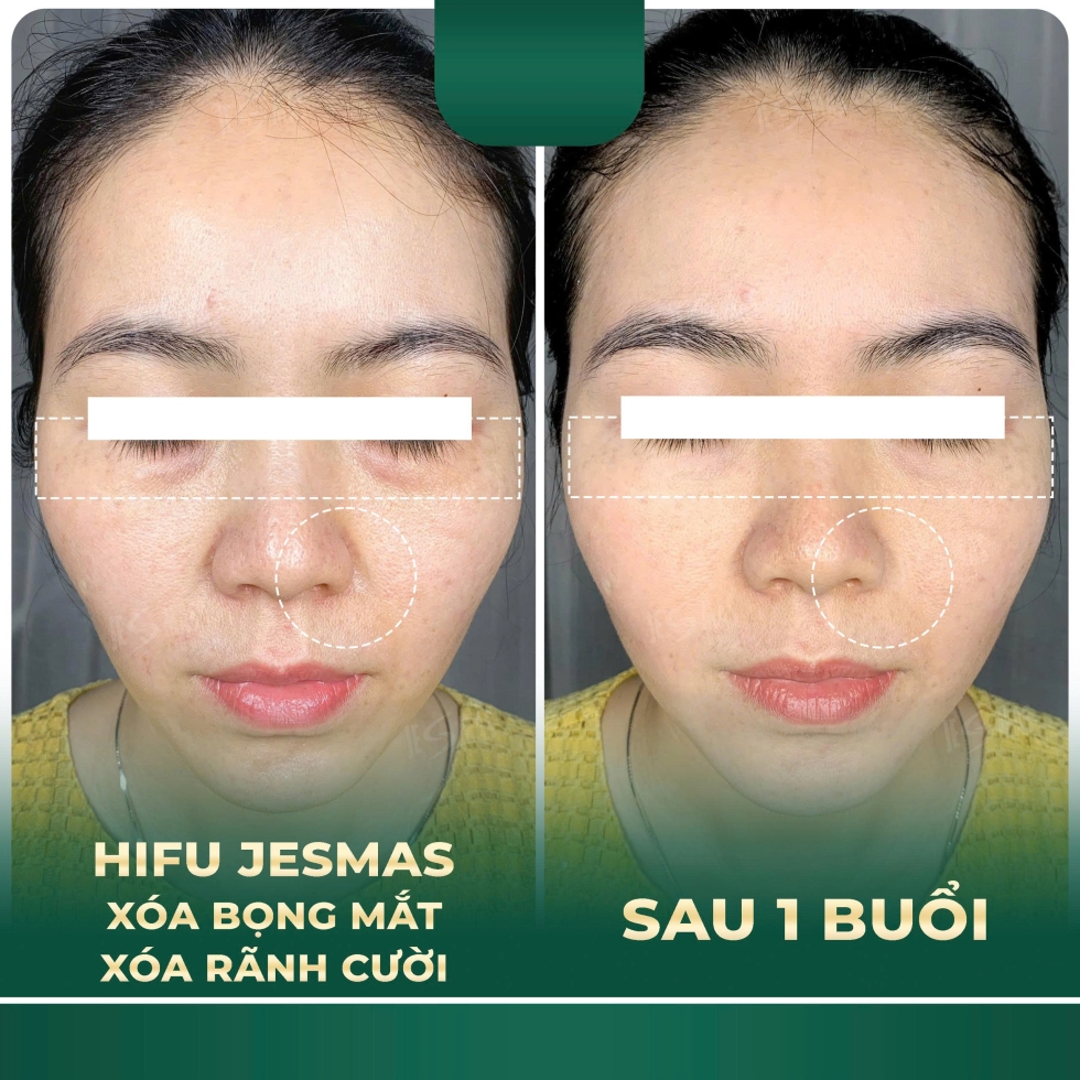 hifuxoabongmat-xoaranhcuoixanhdam2