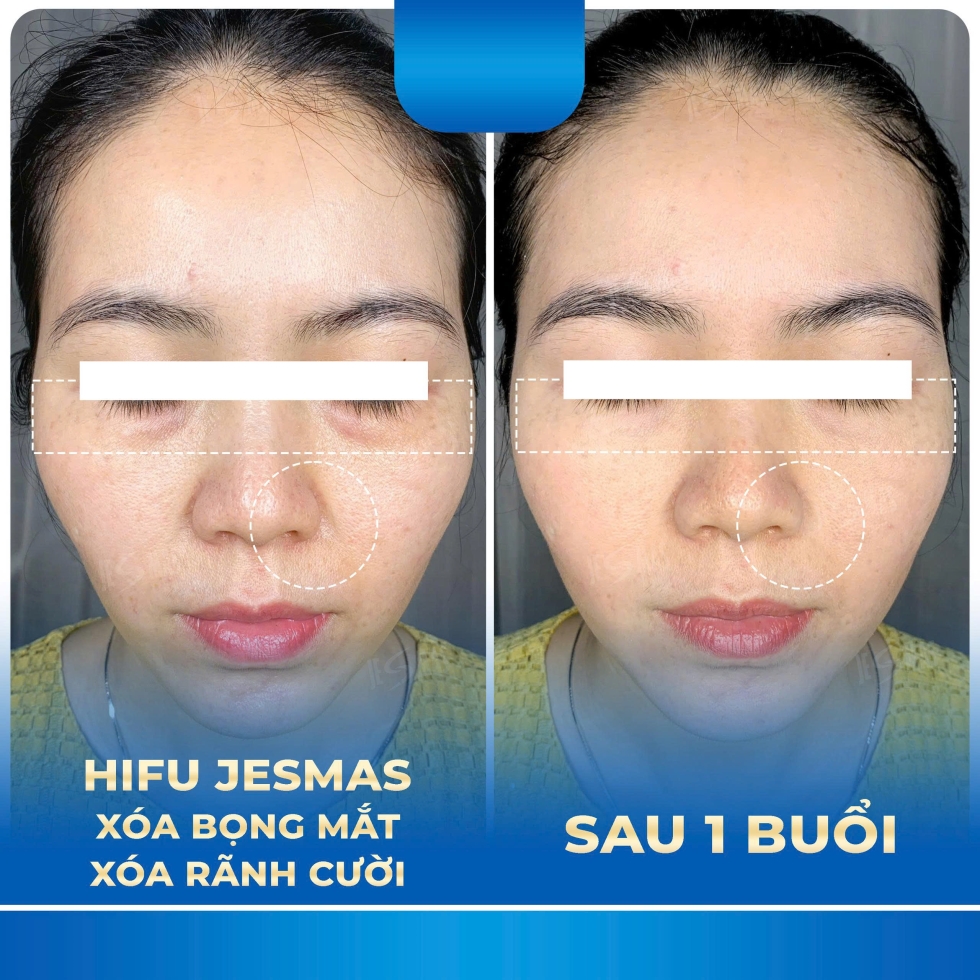 hifuxoabongmat-xoaranhcuoi