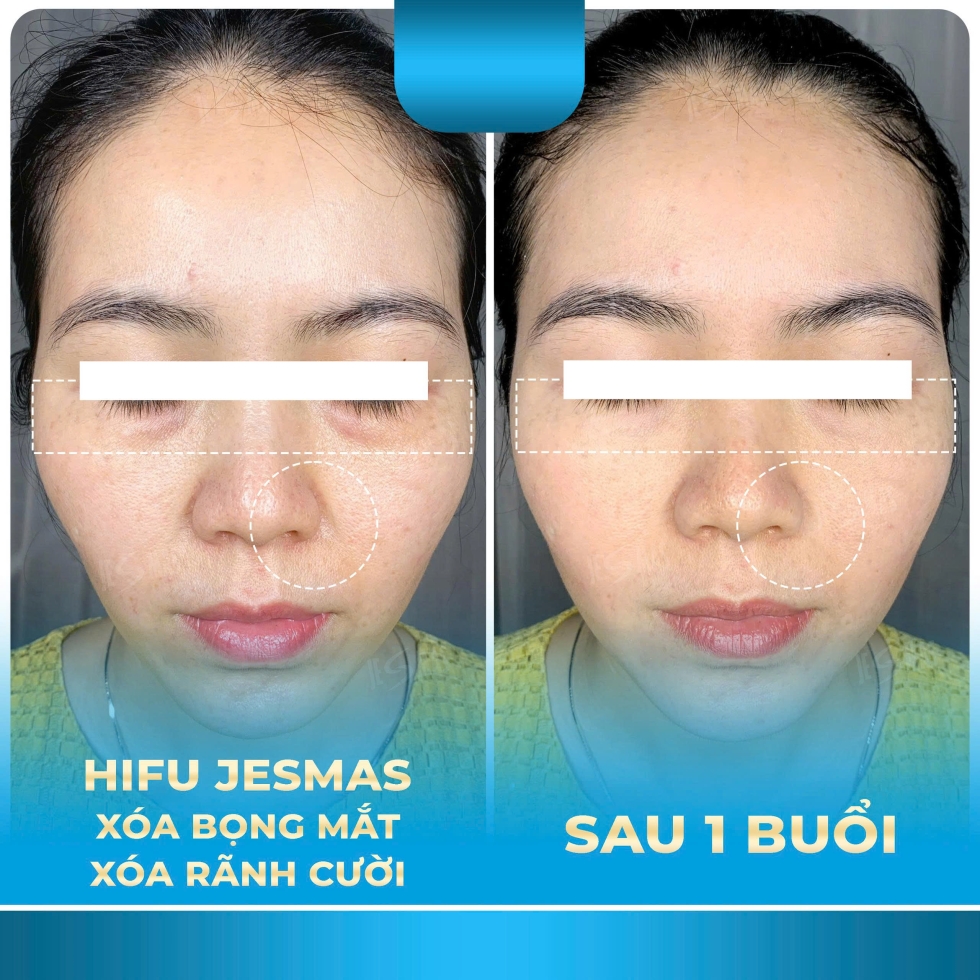 hifuxoabongmat-xoaranhcuoixanhnhat