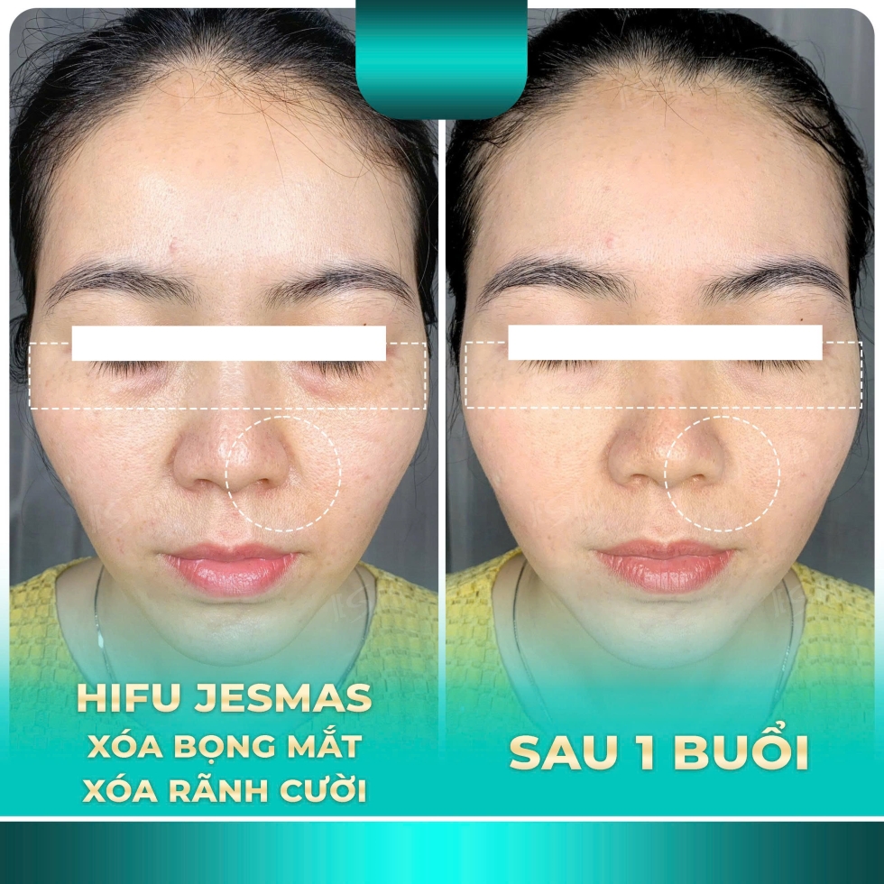 hifuxoabongmat-xoaranhcuoixanhnhat2