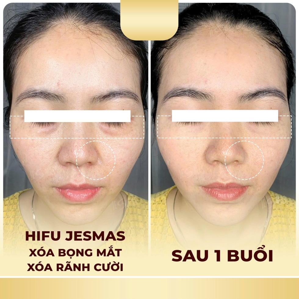 hifuxoabongmat-xoaranhcuoivang