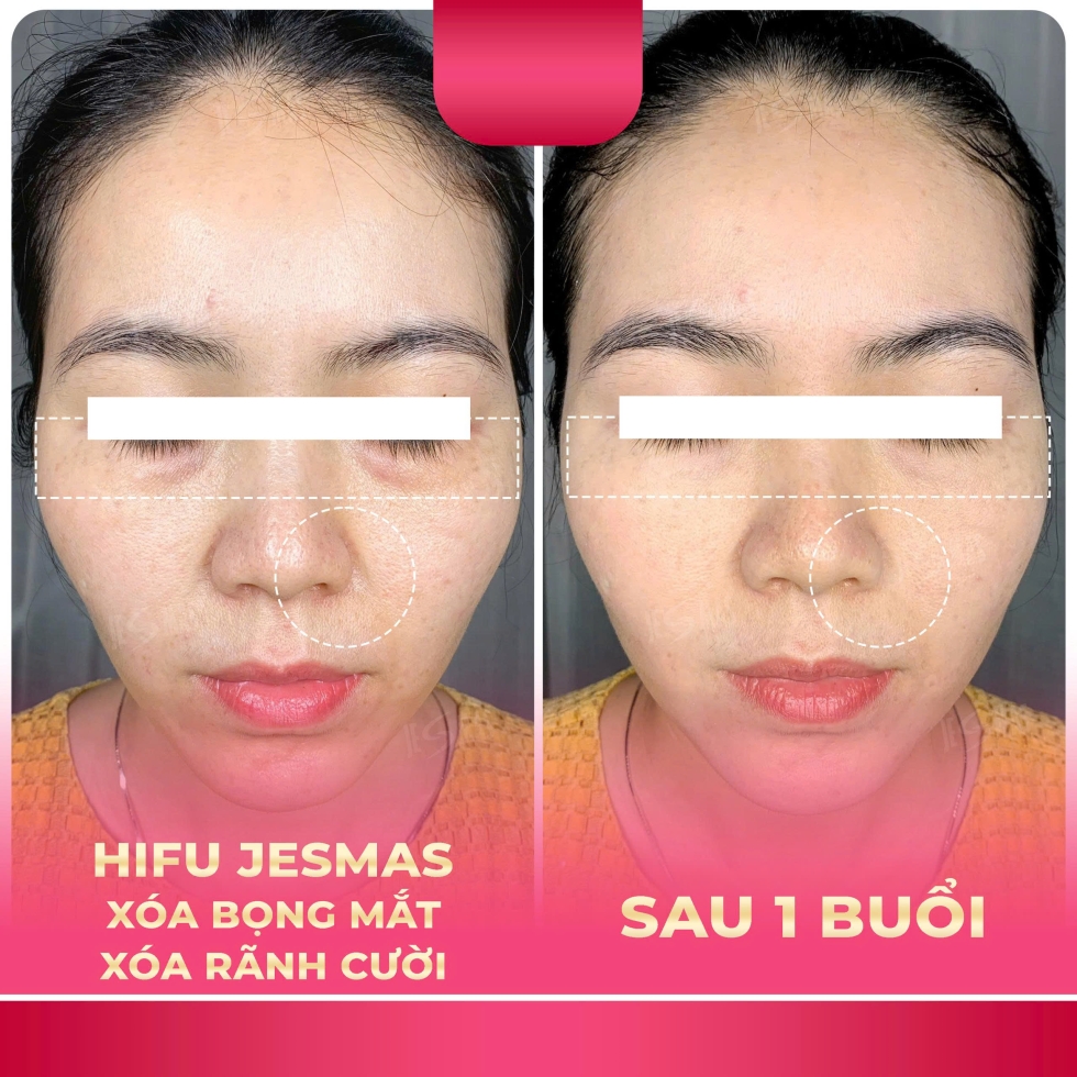 hifuxoabongmat-xoaranhcuoihong