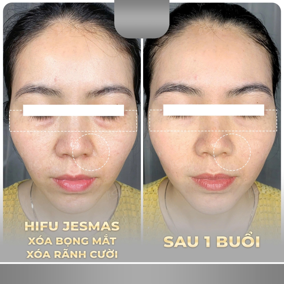 hifuxoabongmat-xoaranhcuoixam