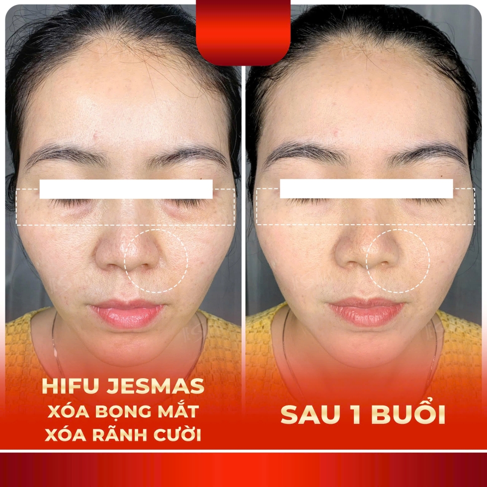 hifuxoabongmat-xoaranhcuoido