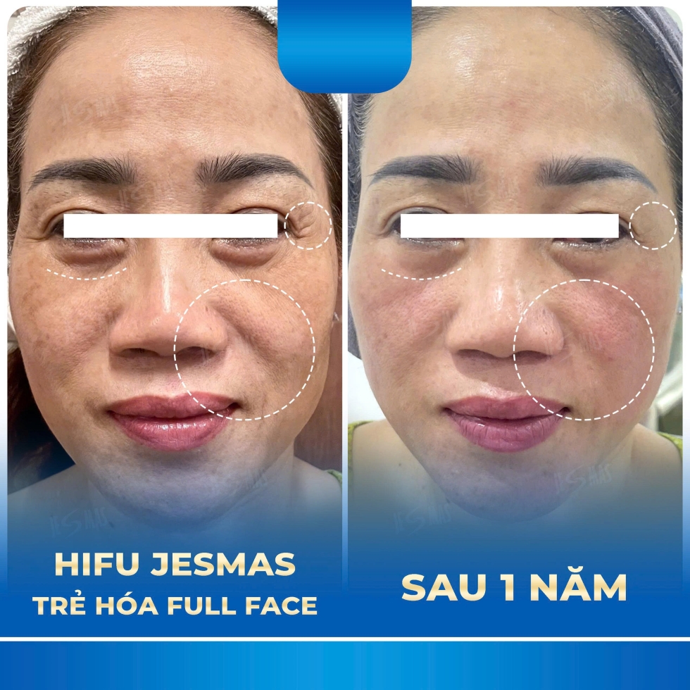 hifutrehoafullfacexanhdam