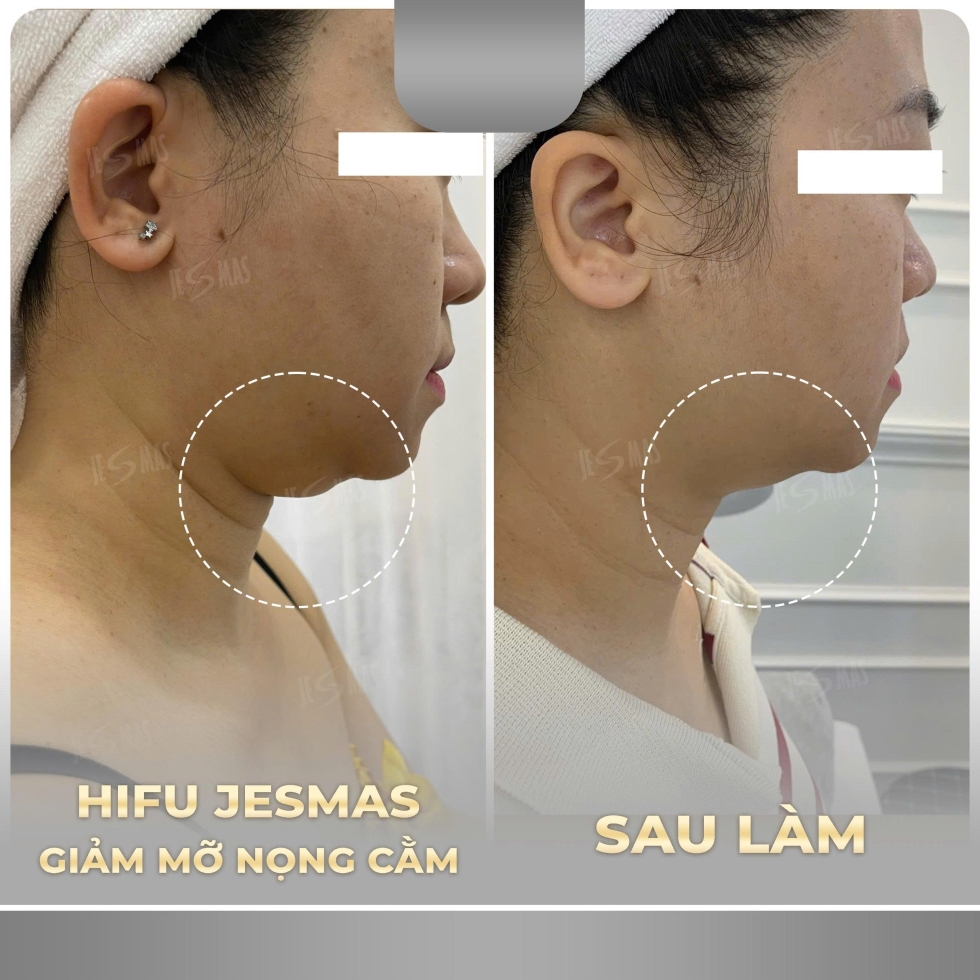 hifugiammonongcamxam
