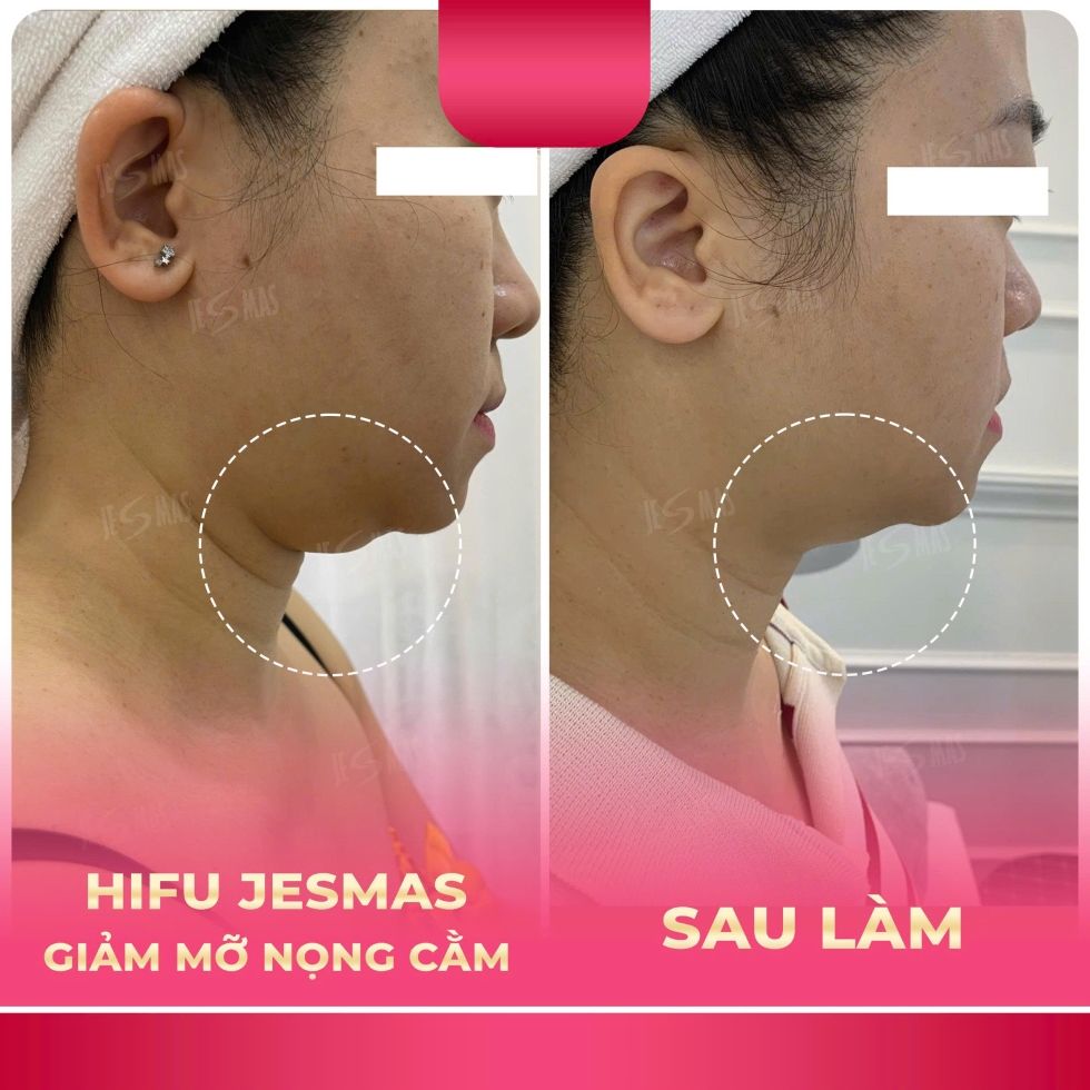 hifugiammonongcamhong