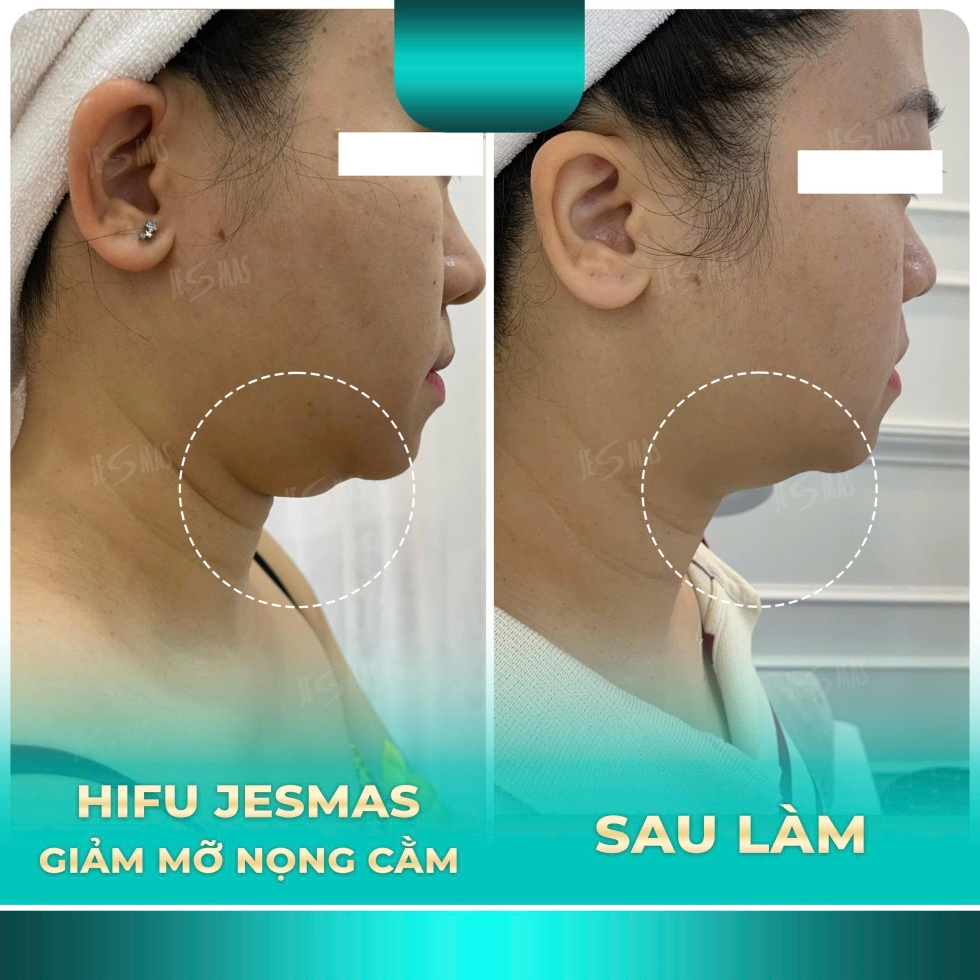 hifugiammonongcamxanhnhat2