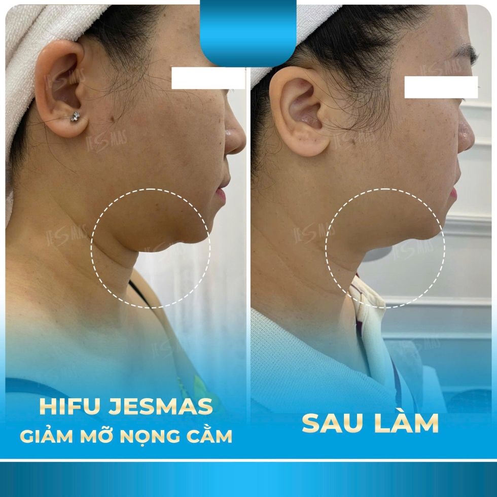 hifugiammonongcamxanhnhat
