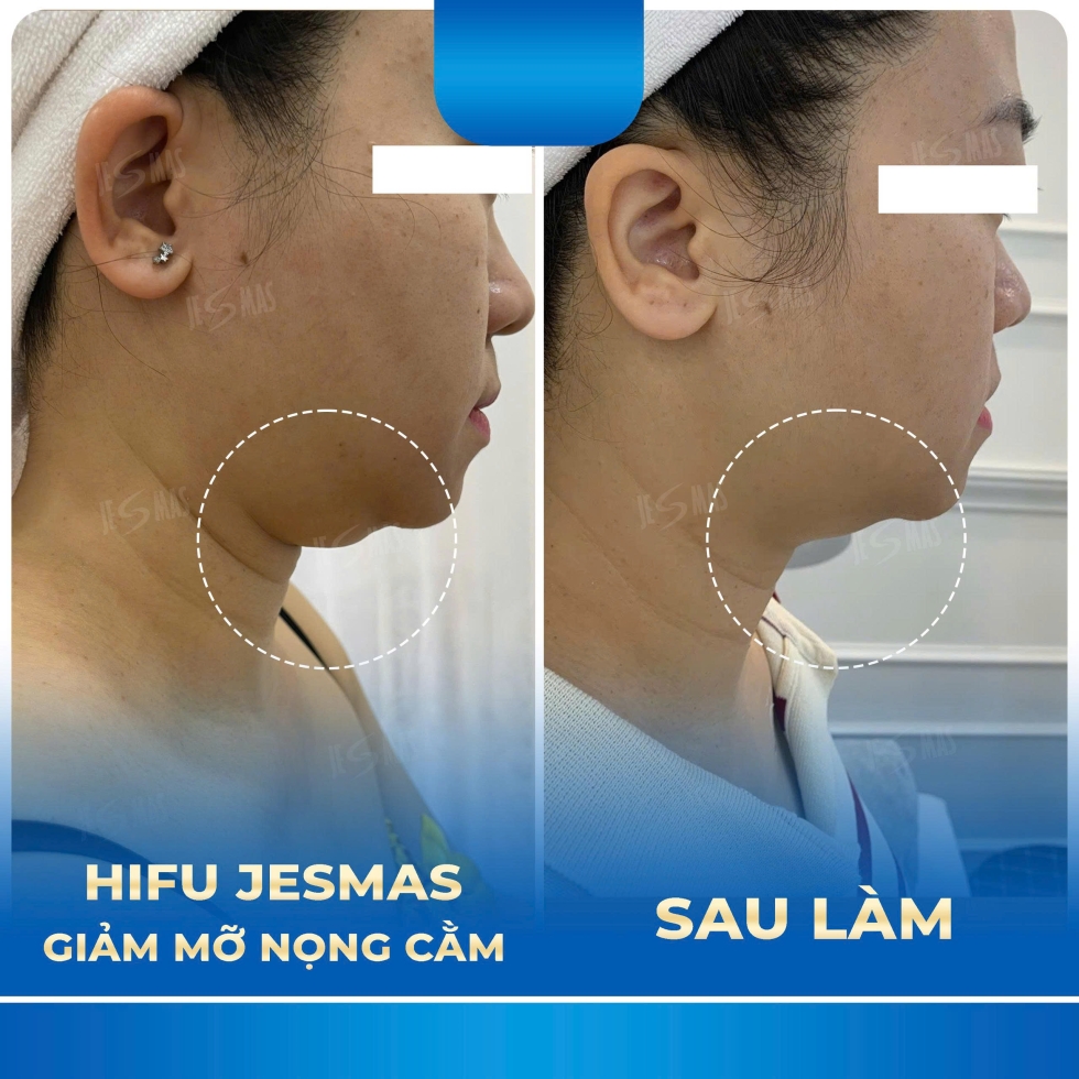 hifugiammonongcamxanhdam